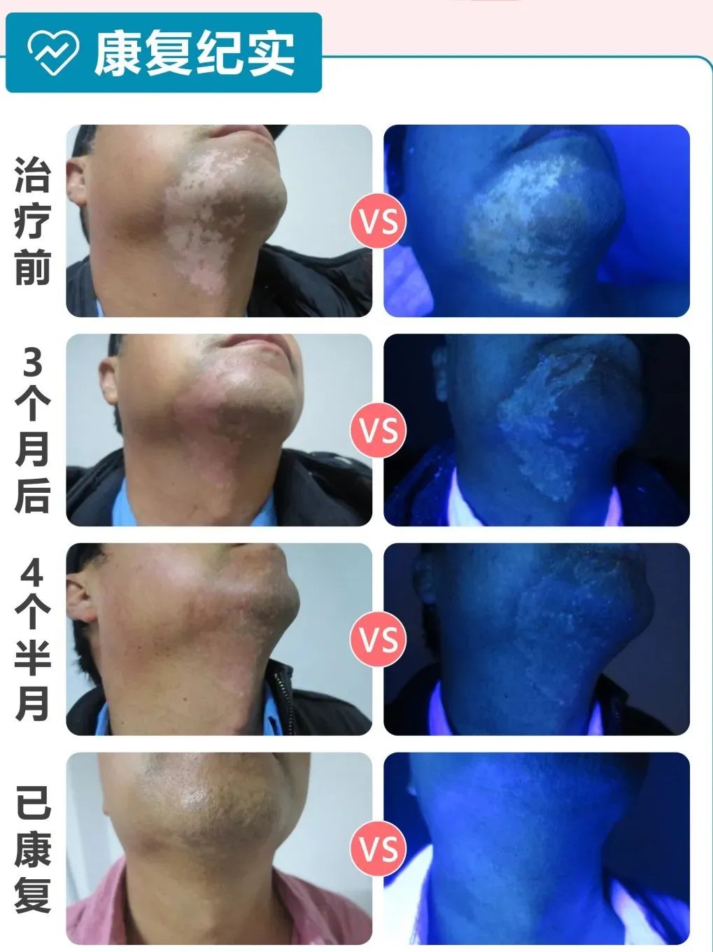 最新白癜风研究新药,白癜风临床试验招募2020