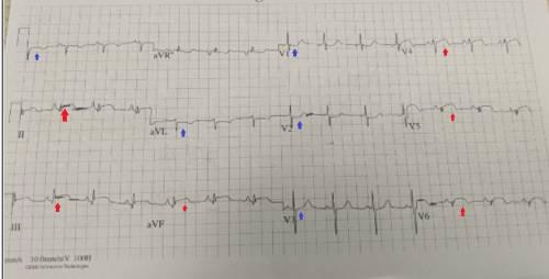 胳膊疼了一晚上是心梗吗,腿疼就是心梗吗