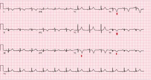 胳膊疼了一晚上是心梗吗,腿疼就是心梗吗