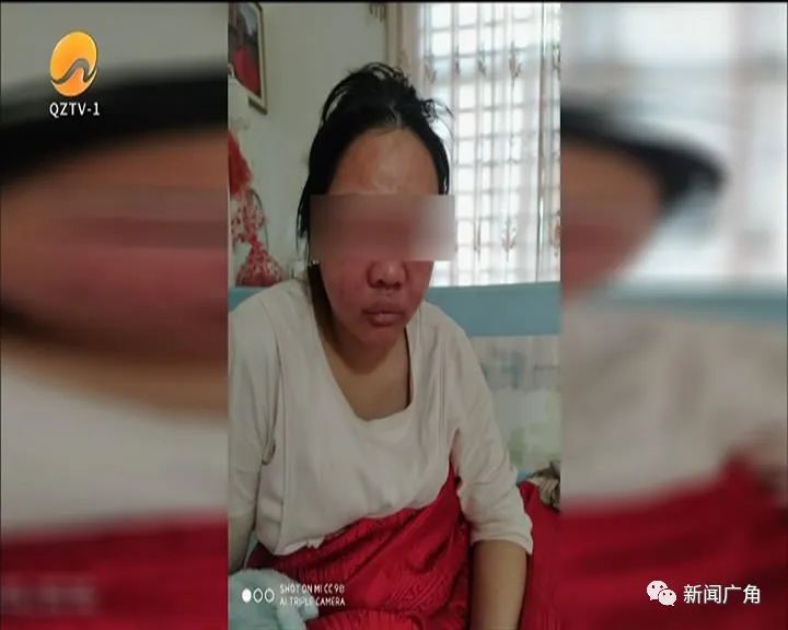 孕妇脸上过敏流脓,孕妇脸上红色丘疹脓包