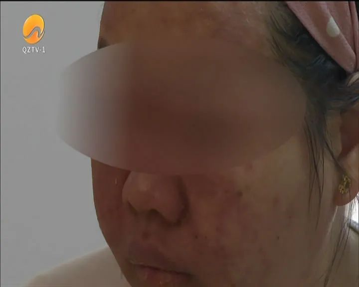 孕妇脸上过敏流脓,孕妇脸上红色丘疹脓包