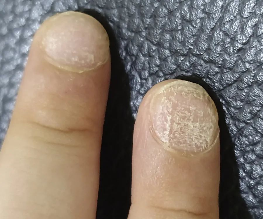 甲萎缩是甲癣吗,甲分离症和甲癣区别