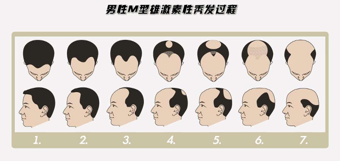 如何拯救“秃”如其来的尴尬？今晚19:30，收看海南卫视，为您揭晓答案