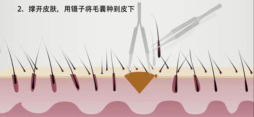 如何拯救“秃”如其来的尴尬？今晚19:30，收看海南卫视，为您揭晓答案