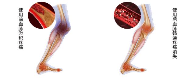 再也不用穿秋裤了!10秒让腿部恒温37度,袪湿又保暖,简直是老寒腿、关节炎的“救星”