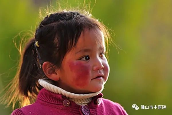 冬天干敏肌肤泛红怎么修复,秋冬季皮肤敏感泛红怎么护理