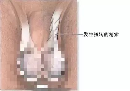 摔了一跤睾丸会扭转吗,摔了一跤睾丸出血