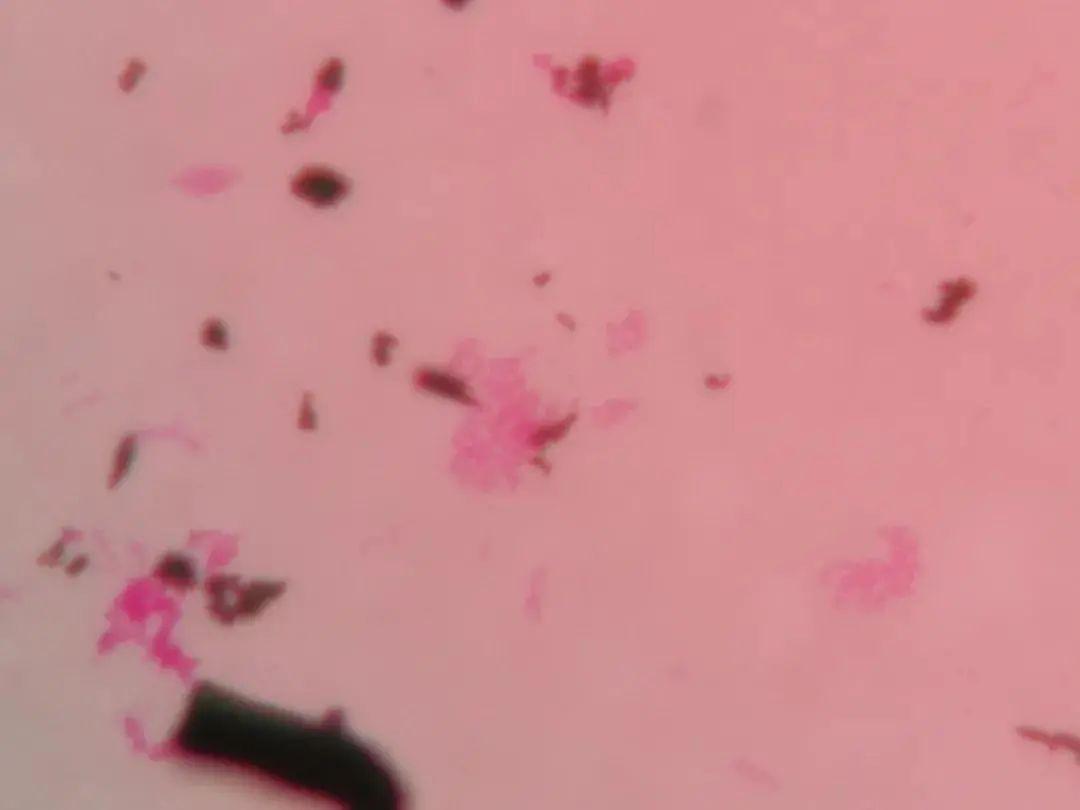 喝了口“现挤鲜奶”,足足发烧了5天,还差点要了命