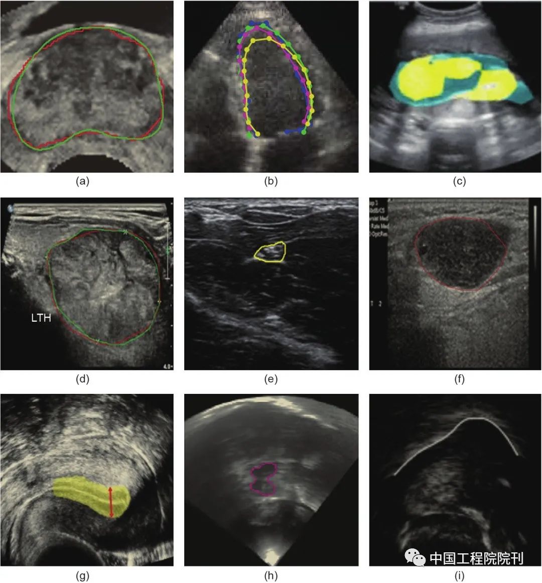 超声图像在医学领域的应用,深度学习和超声成像