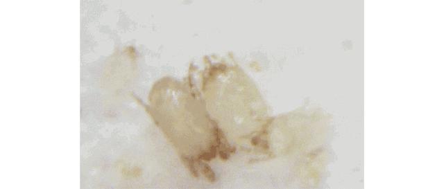 痘痘闭口挤出来的是什么,闭口痘痘挤出来白色物质