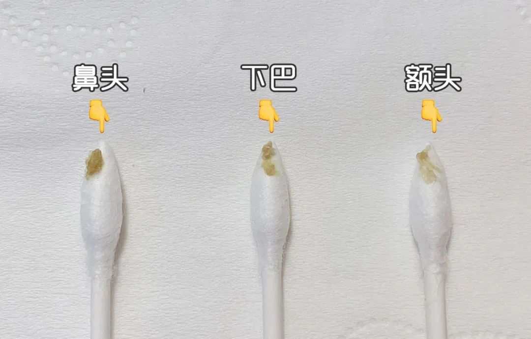 痘痘闭口挤出来的是什么,闭口痘痘挤出来白色物质