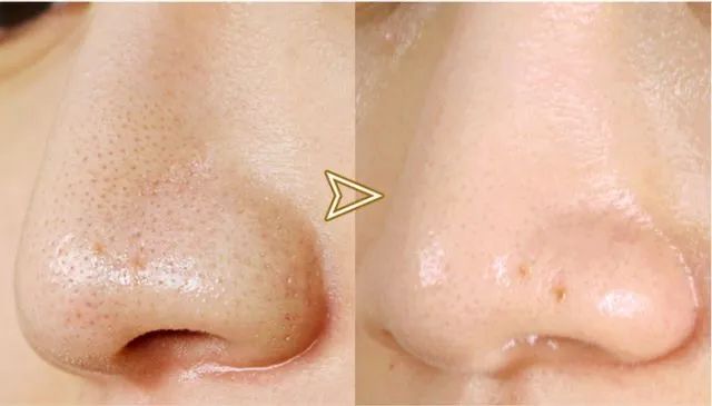 痘痘闭口挤出来的是什么,闭口痘痘挤出来白色物质