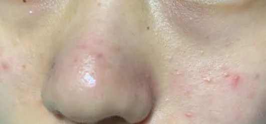 痘痘闭口挤出来的是什么,闭口痘痘挤出来白色物质