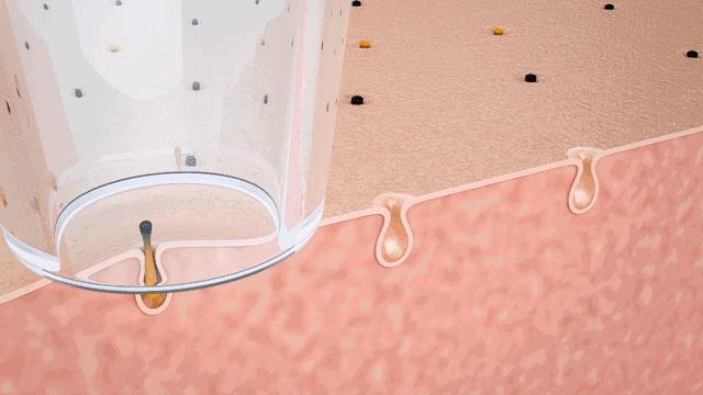 痘痘闭口挤出来的是什么,闭口痘痘挤出来白色物质