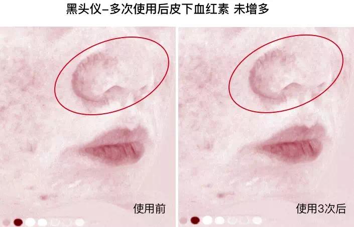 痘痘闭口挤出来的是什么,闭口痘痘挤出来白色物质