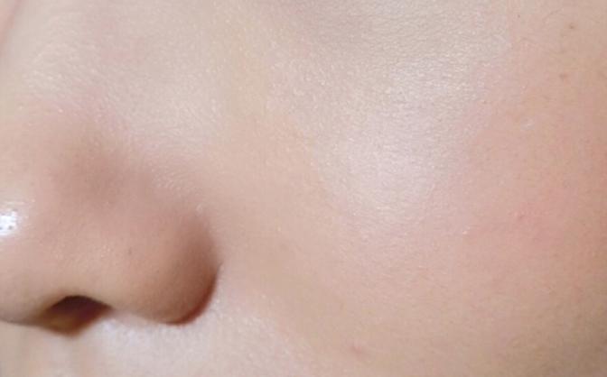 痘痘闭口挤出来的是什么,闭口痘痘挤出来白色物质