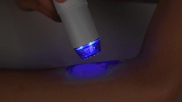 痘痘闭口挤出来的是什么,闭口痘痘挤出来白色物质