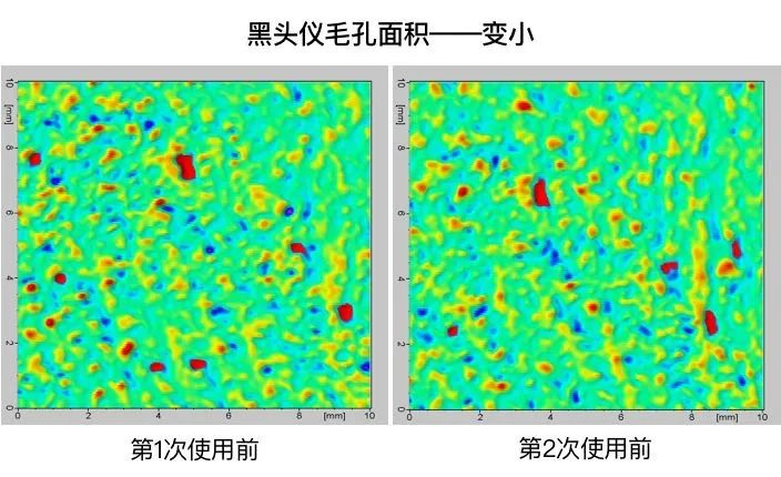 痘痘闭口挤出来的是什么,闭口痘痘挤出来白色物质