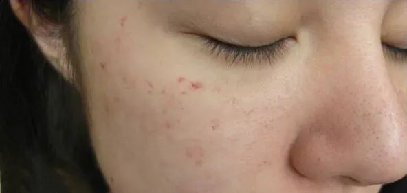 痘痘闭口挤出来的是什么,闭口痘痘挤出来白色物质