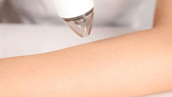 痘痘闭口挤出来的是什么,闭口痘痘挤出来白色物质