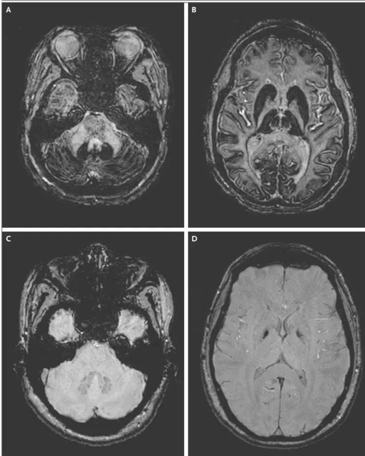 铜蓝蛋白缺乏症看哪个科,铜蓝蛋白偏低能引发什么病症