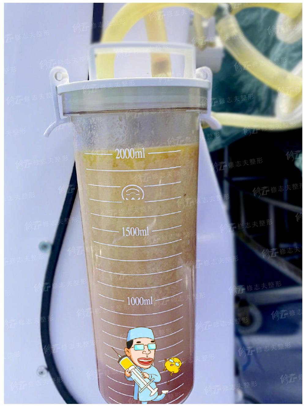 抽出来的脂肪为什么是液体,抽出来的脂肪去哪里了