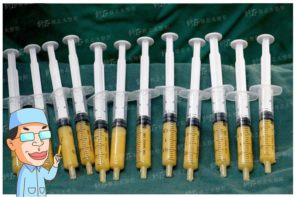 抽出来的脂肪为什么是液体,抽出来的脂肪去哪里了