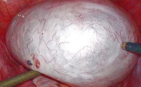 从“卵巢囊肿”到“卵巢癌”,究竟需要多久?