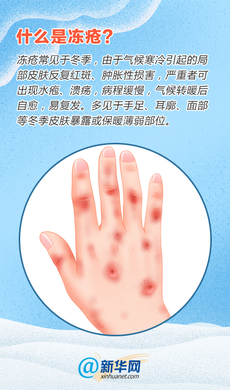 如何缓解冻疮的手痒,冻疮痒的快速消除方法