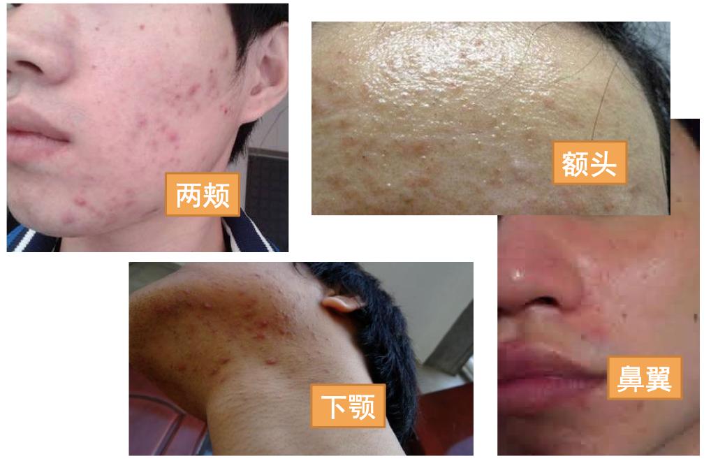 还在用洗面奶、磨砂膏？这款肌肤吸尘器，天然去角质，深度清洁毛孔，用完后整张脸都透气了