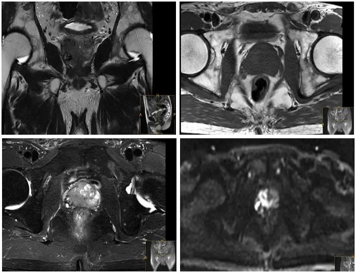 疫情期间进展为mCRPC阶段高危患者，醋酸阿比特龙可迅速控制病情|经典病例