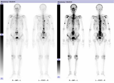 疫情期间进展为mCRPC阶段高危患者，醋酸阿比特龙可迅速控制病情|经典病例