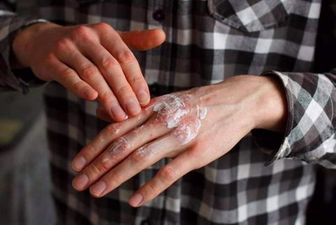 湿疹反复发作能否转为皮炎,为啥脸上皮炎湿疹会反复发作呢