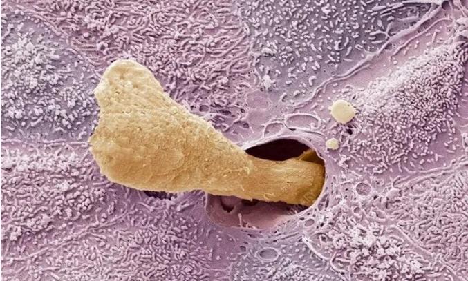 生下来没耳朵,婴儿耳朵里挖出来的耳屎粘稠还臭