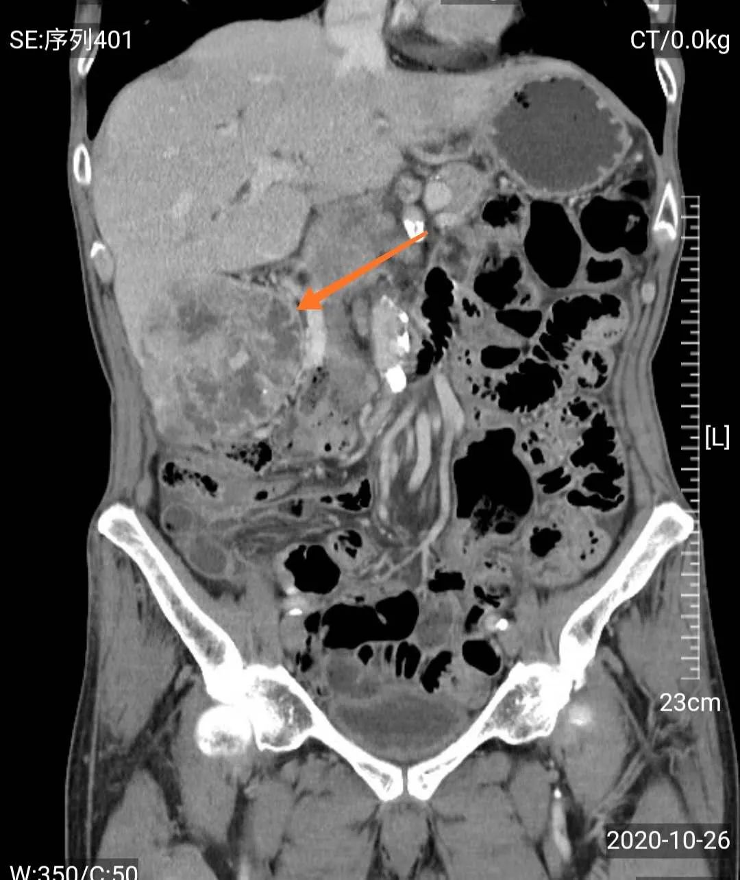 【警惕】耄耋老人患巨大肾癌，佛中医泌外团队3D腹腔镜微创治愈