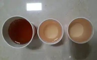 【警惕】耄耋老人患巨大肾癌，佛中医泌外团队3D腹腔镜微创治愈