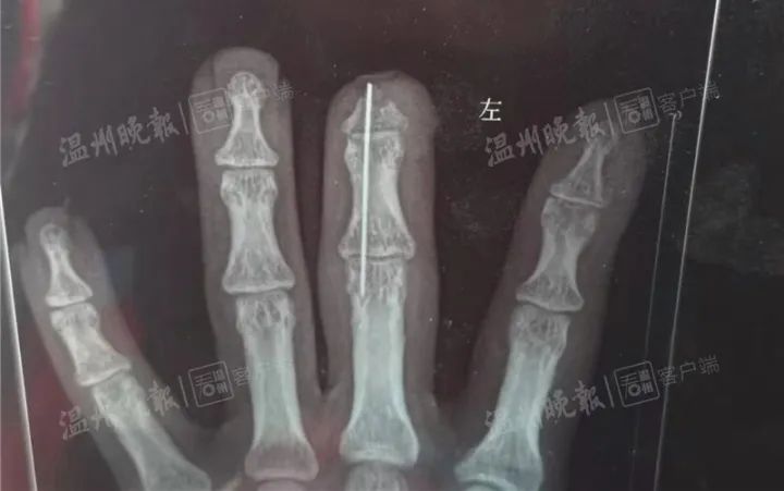 浙江一男子受伤，做完手术后短了一截？！医院回应了……