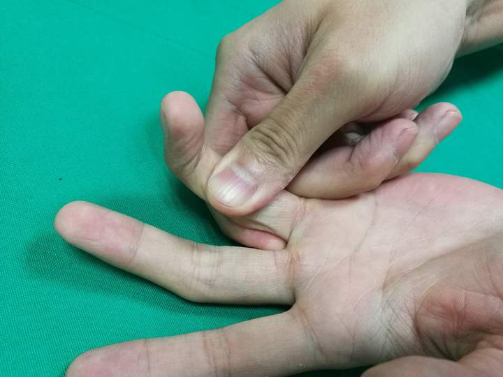 爱打打篮球的富阳小伙，一不小心戳出“锤状指”，正确处理方式应该是这样