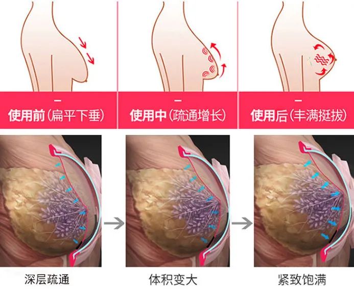 怎么丰胸安全又见效快不用吃药,丰胸除了按摩有什么方法