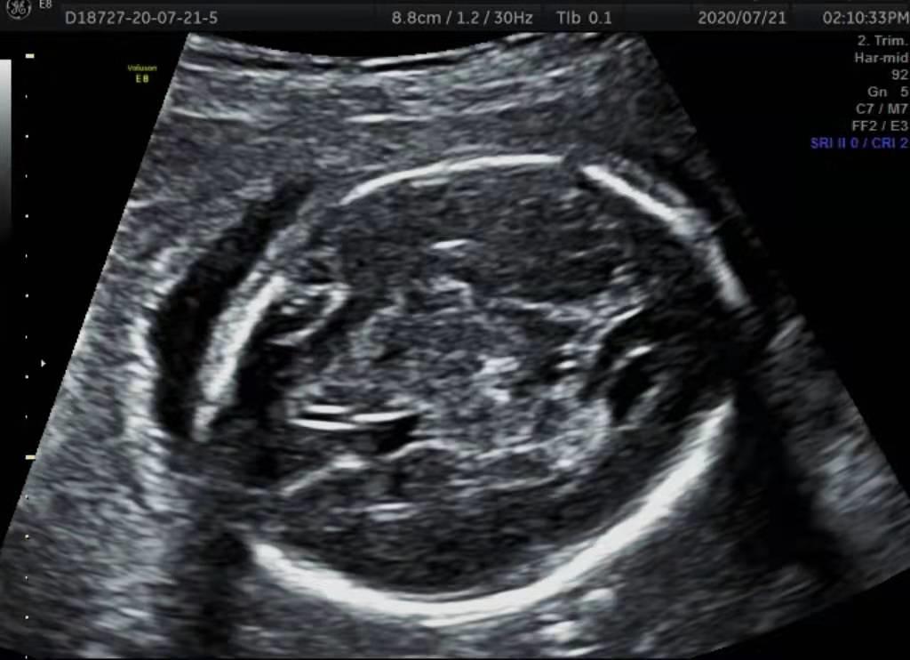 产检B超做二维、三维还是四维?