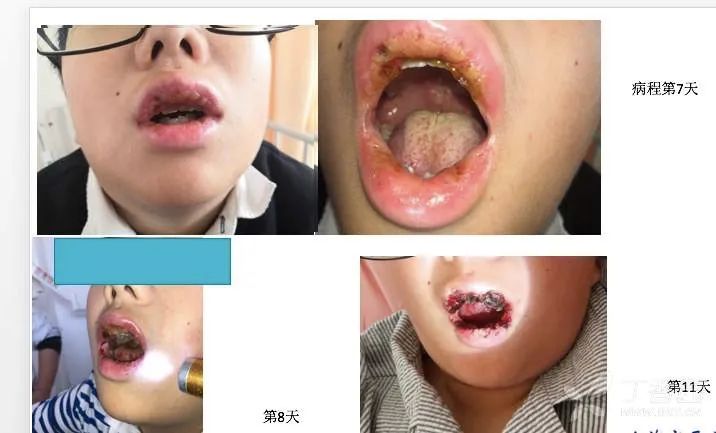 一样的扁桃体化脓，不一样的诊治