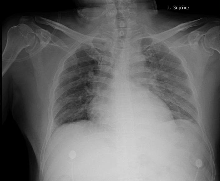房颤术后出现胸闷气喘咳嗽,房颤消融术后2个月胸痛怎么办