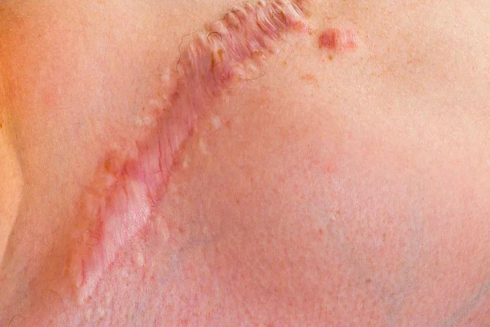 淡化疤痕原来淡疤可以这样做,每天用它擦一擦轻轻松松去除疤痕