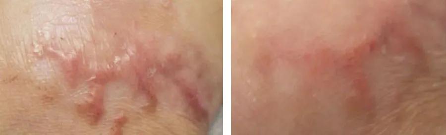 淡化疤痕原来淡疤可以这样做,每天用它擦一擦轻轻松松去除疤痕