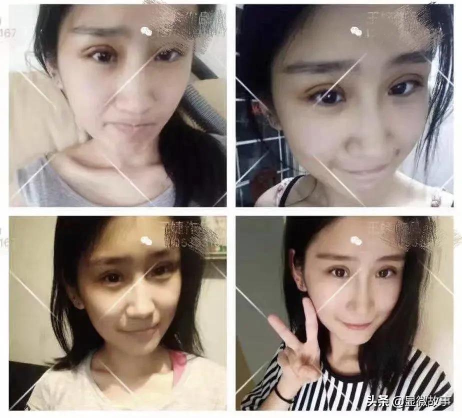花三万块钱整容,4万元整容成歪鼻子