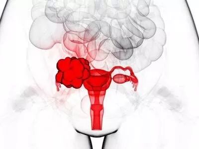 避免卵巢癌,卵巢癌被称为沉默的女性杀手