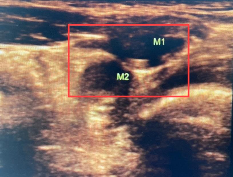 先天性睾丸消失,蛋蛋去哪里了