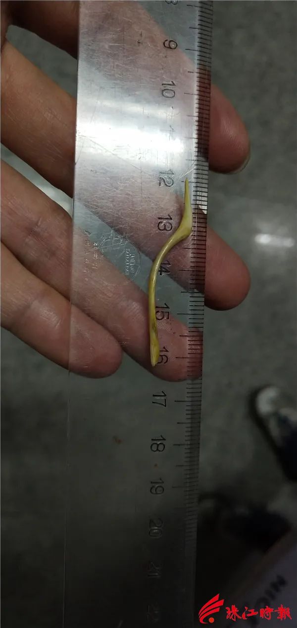 吃了冬瓜炖鱼汤，佛山一女子小肠被鱼刺刺穿！主诊医生：她算是幸运的