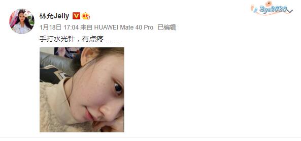 林允打水光血珠,林允打水光针术后恢复