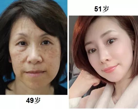 花了3万做激光,才彻底懂了:医生为什么劝你别去斑